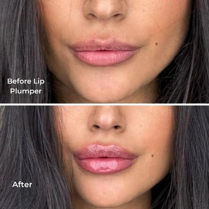 Vellano LipLift™